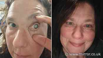 'Contact lenses caused parasite to eat my eye - now I need it removed'