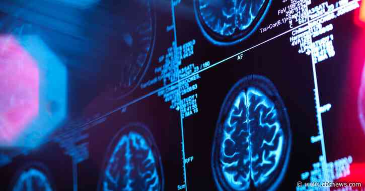 Piedmont Atlanta expands Gamma Knife radiosurgery program for brain tumors and neurological conditions