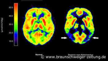 Forscher warnen: Beliebtes Gelenkmittel könnte Demenz-Risiko erhöhen