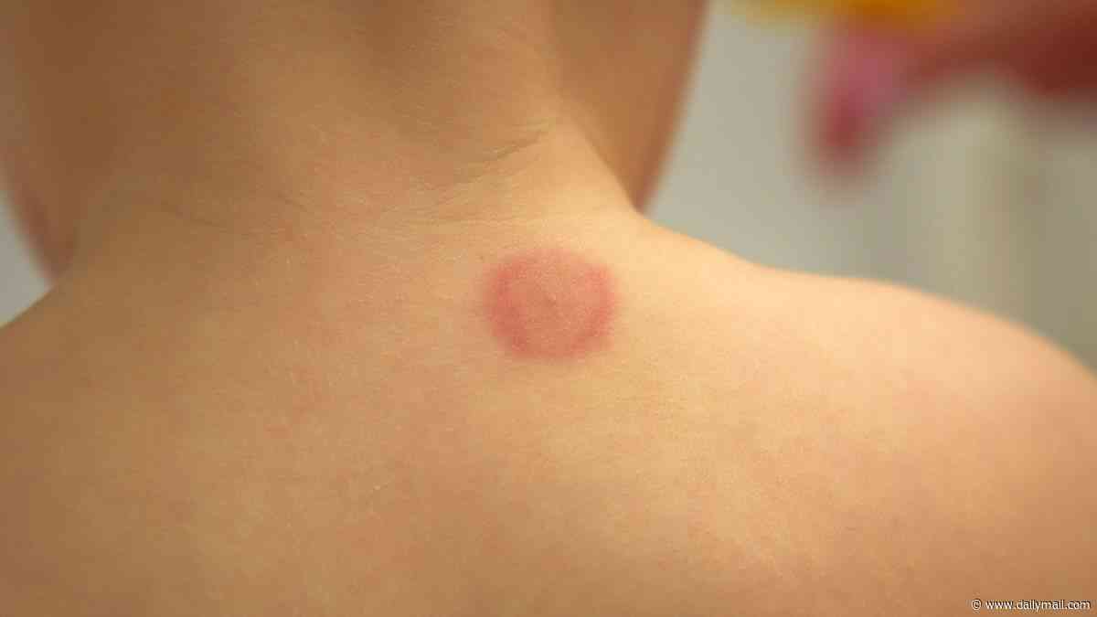 The subtle signs your insect bite has triggered a life-ruining illness, according to pharmacist