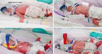Australian woman gives birth to rare identical quadruplets