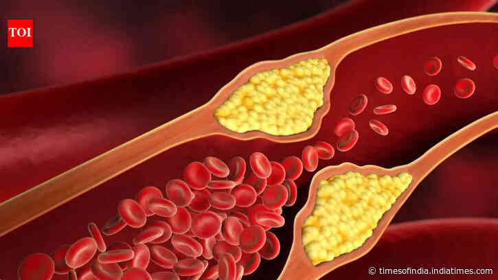 High cholesterol doesn’t always stay silent: 7 warning signs that could appear on your eyes, skin, and legs