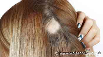 Weight loss drugs linked to increased risk of hair loss