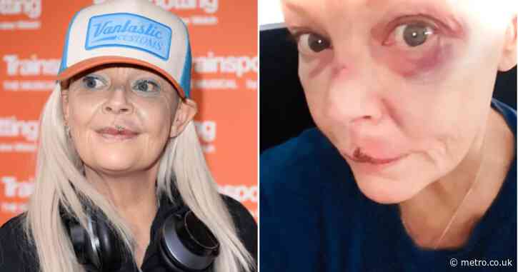 Gail Porter suffers agonising facial injuries after being knocked down Tube stairs