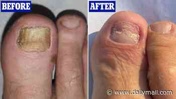 My crusty yellow toenails looked like an animal's claws and disgusted my children. But I cured them for ever with a simple, life-changing treatment. Here are the steps I took: SIMON MILLS
