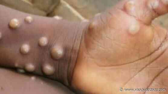 Mpox: Benue investigates suspected cases in Konshisha LG