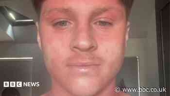 Skin cream withdrawal pain 'like being electrocuted' left student stuck in bed