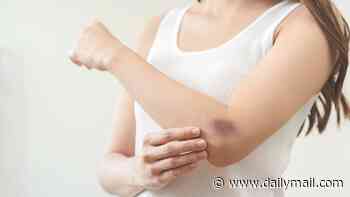 Bruise easily? When to ignore your black and blues and when they're a sign of something sinister