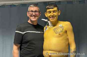 Cheshire man turns bright yellow ‘like Bart Simpson’ due to rare, life-threatening disease