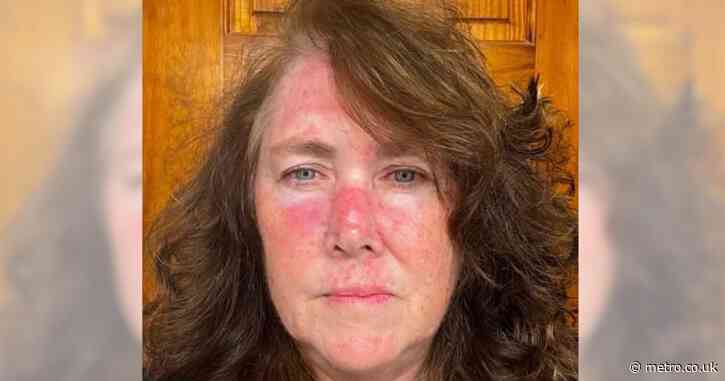 Shocking photos reveal mum-of-one’s skin cancer ordeal