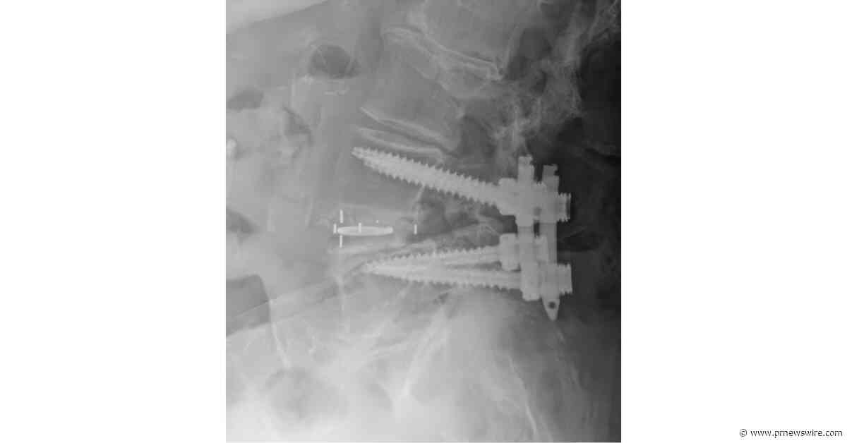 Spinal Elements Launches Luna® Ti