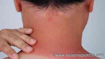 Sunburn relief: Dermatologist-approved methods that actually work