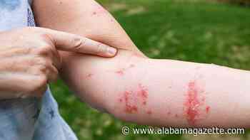 6 ways to get rid of poison ivy rash symptoms fast