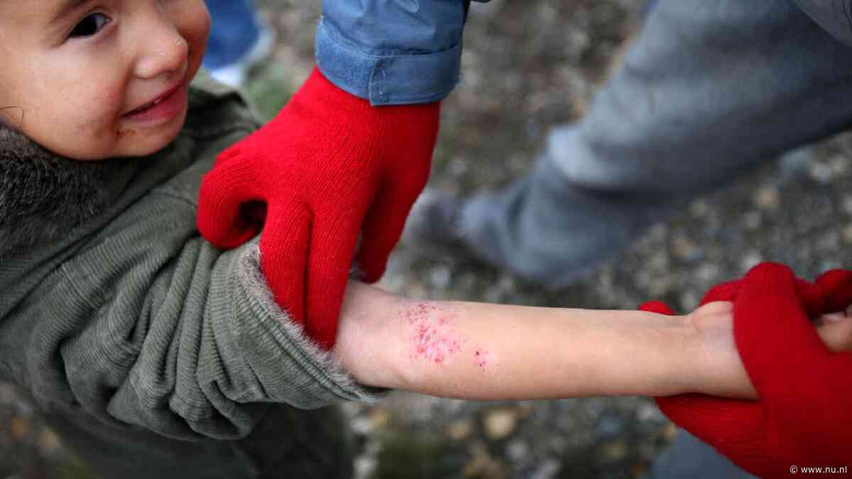 Schurftepidemie in Nederland blijft hardnekkig: 'Er is geen magic bullet'
