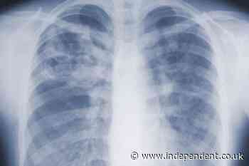 Deadly mold infections may be far more common than doctors realized, CDC study finds
