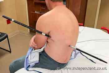 Miracle escape for man who walked 10 miles with steel pole piercing his body