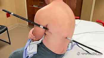 ''Tis but a flesh wound': Montana man hikes 6 hours impaled by trekking pole