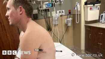 Man impaled by a hiking pole treks 10 miles down mountain