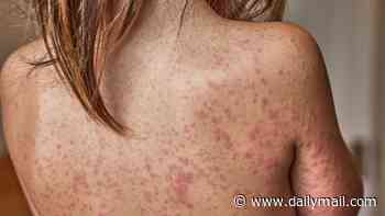 Getting frequent colds and fevers increases children's chance of developing eczema, study reveals