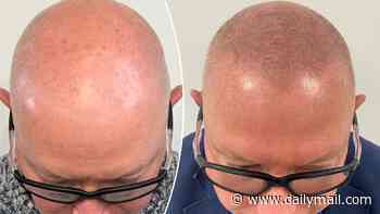 The unlikely solution for male hair loss that avoids both medication and costly transplant surgery - and it can achieve an instant transformation