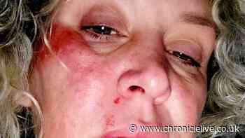 'Pothole left me covered in blood picking up my own teeth and now I want compensation'