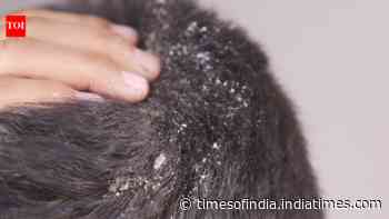 5 hair oils that may be making your dandruff worse