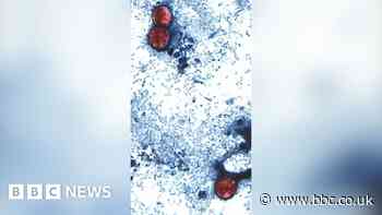 US reports first two deaths linked to parasitic infection outbreak