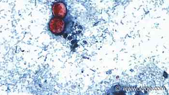 Over 20K cyclosporiasis cases suspected in US as outbreak reportedly linked to 6 more states