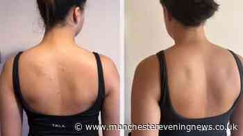 Mature shopper-loved £15 solution that rids dry bumpy 'chicken skin' without lasers