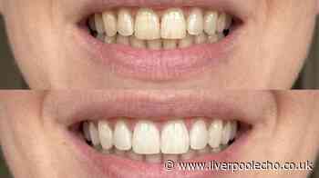 'I finally have a solution for yellow teeth' with kit that's £43 off in final hours