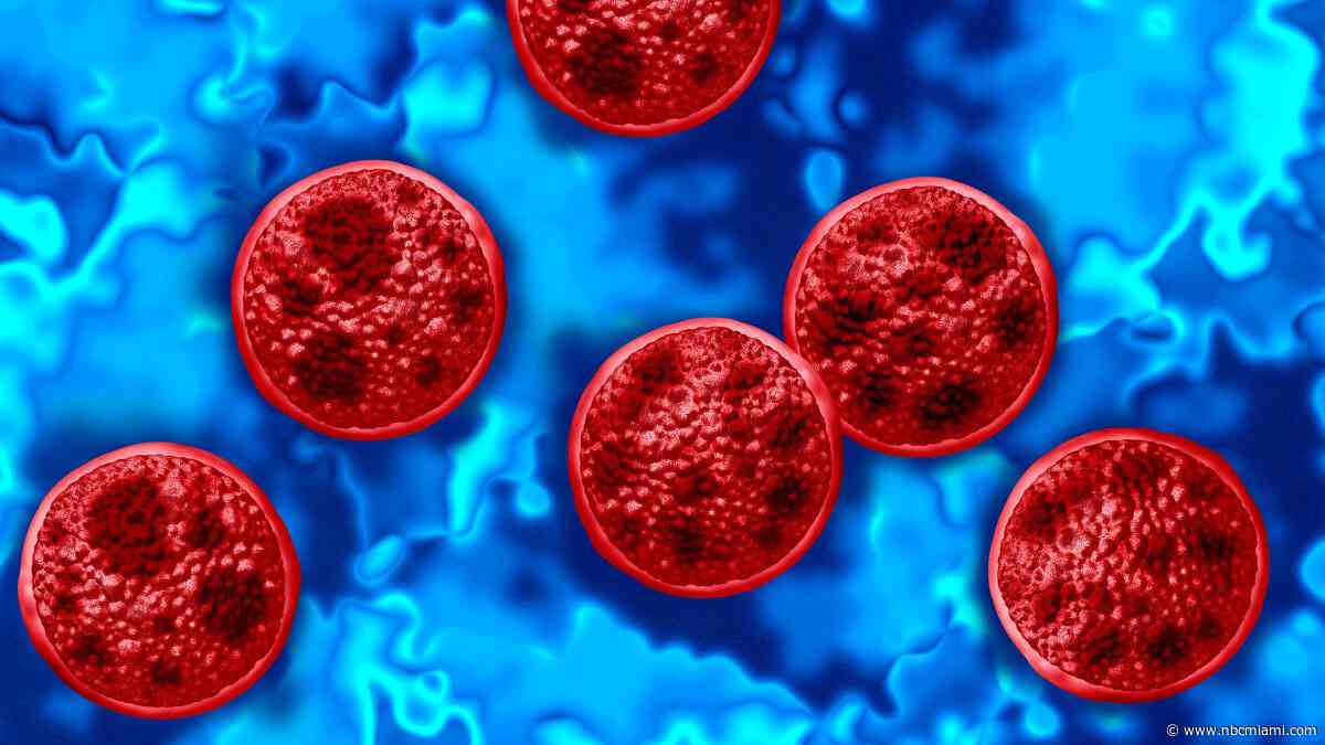 Cyclosporiasis outbreak continues to grow in Florida, with around 100 new cases