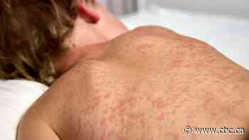 Measles cases continue to drop in Manitoba, with just 2 confirmed in July