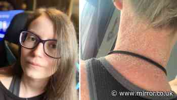 NHS worker with psoriasis ‘couldn’t move without skin splitting’ before £11 buy