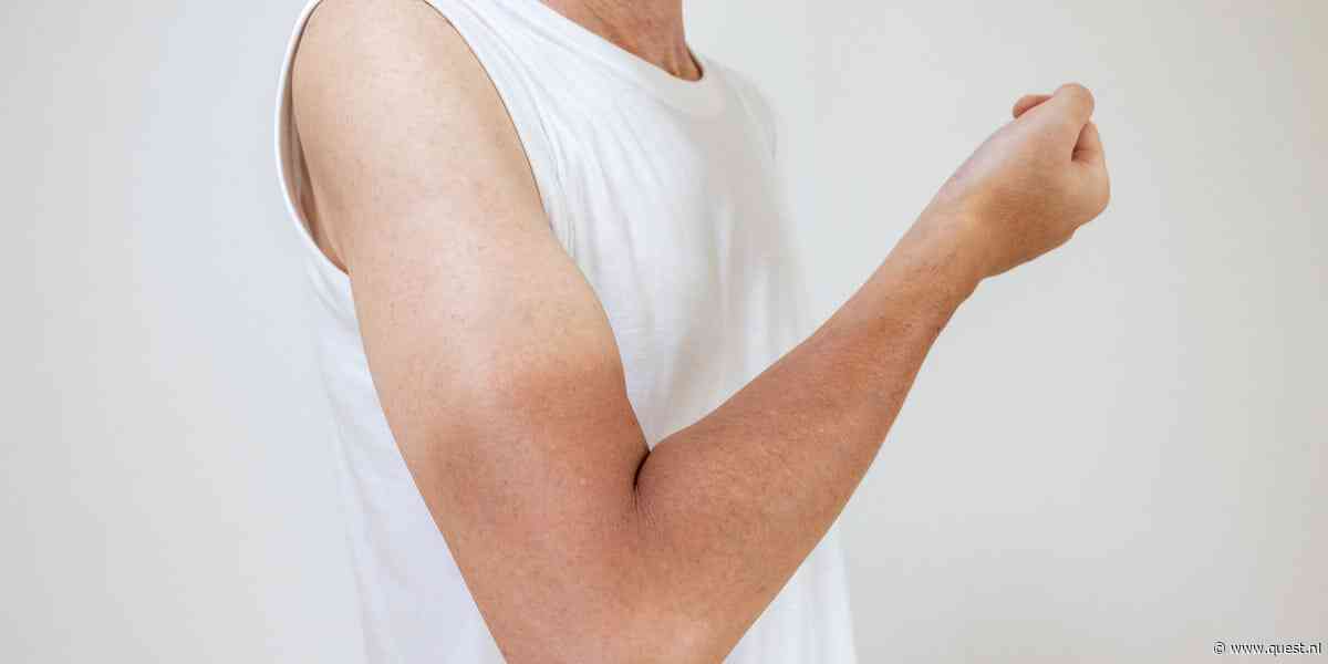 Helpt aftersun als je verbrand bent?