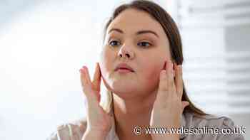 'I'm no longer embarrassed to go out’ with rosacea cream that ‘keeps cheeks calm’