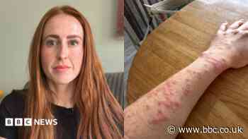 Woman attacked by bed bugs during Travelodge stay