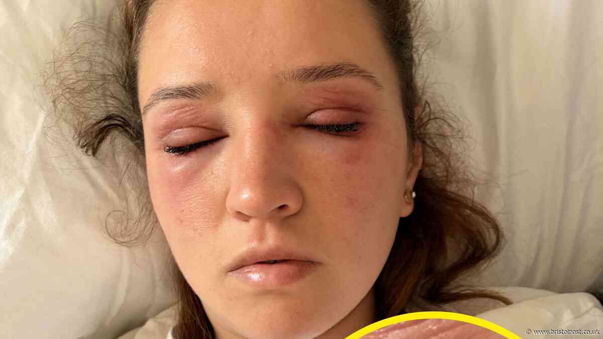'I ended up in A&E when had horror reaction to wedding eyelashes'