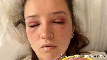 'I ended up in A&E when had horror reaction to wedding eyelashes'