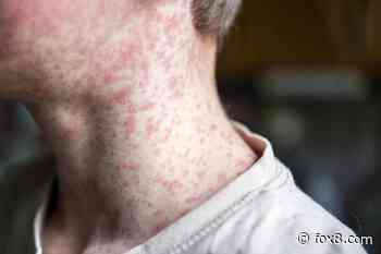 Suspected measles exposure at University Hospitals Rainbow Babies & Children's Hospital