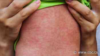 Manitoba measles cases hit lowest point in over a year, but experts warn infections could spike again