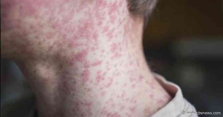 Health Watch: Measles cases highest in 3 decades, hospitals push for upfront payments