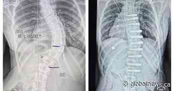Alberta teen’s family sues government after nearly $200K out-of-country surgical bill