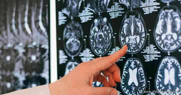 Toxoplasma, svelato il segreto del parassita che si nasconde nel cervello. Lo studio Usa