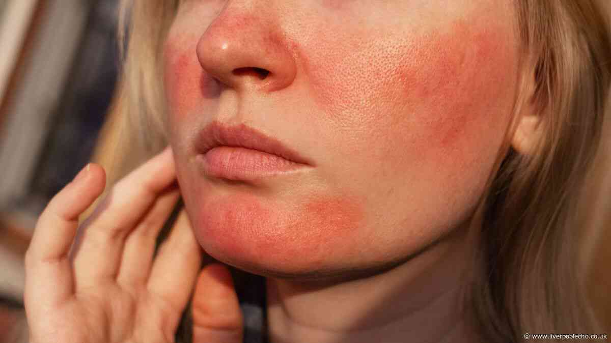 'Best product I've used' for rosacea is £13 cream that 'improved redness' in a week