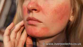 'Best product I've used' for rosacea is £13 cream that 'improved redness' in a week