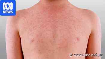 Study warns of measles risk with 1.7 million Australians vulnerable
