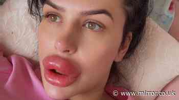 Woman injects ger own lip fillers at home after doctors refused