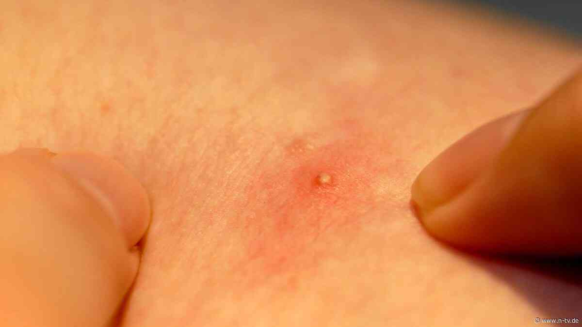 Besser als Ablenkung: Aufmerksamkeit kann akute Entzündungen der Haut reduzieren