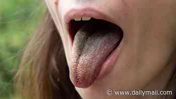 I've had a black tongue for over a year. Scraping hasn't helped and it's so unsightly. What's wrong with me? DR SCURR reveals the little-known condition that affects so many... and what it means for your health