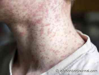 Alberta measles cases drop to zero, but doctor warns of outbreak risk